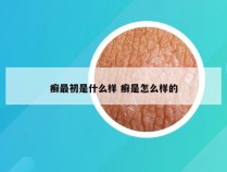 癣最初是什么样 癣是怎么样的