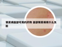 银屑病面部可用的药物 面部银屑病用什么洗脸