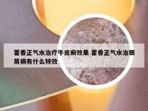 藿香正气水治疗牛皮癣效果 藿香正气水治银屑病有什么特效