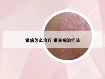 银病怎么治疗 银肖病治疗法