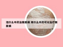 泡什么中药治银屑病 用什么中药可以治疗银屑病