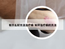 有什么好方法治疗癣 如何治疗癣的方法