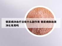 银屑病净血疗法有什么副作用 银屑病做血液净化有用吗