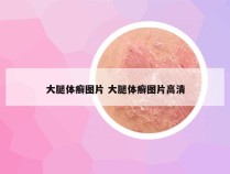 大腿体癣图片 大腿体癣图片高清