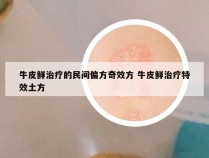 牛皮鲜治疗的民间偏方奇效方 牛皮鲜治疗特效土方