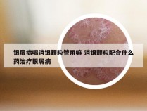 银屑病喝消银颗粒管用嘛 消银颗粒配合什么药治疗银屑病