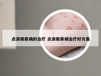 点滴银屑病的治疗 点滴银屑病治疗好方案