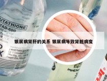 银屑病肾肝的关系 银屑病导致肾脏病变