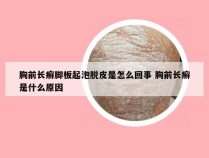 胸前长癣脚板起泡脱皮是怎么回事 胸前长癣是什么原因