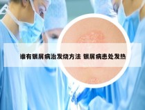 谁有银屑病治发烧方法 银屑病患处发热