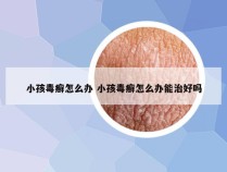 小孩毒癣怎么办 小孩毒癣怎么办能治好吗