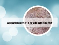 大腿内侧长癣图片 儿童大腿内侧长癣图片