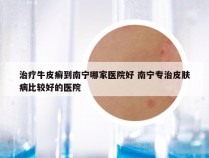 治疗牛皮癣到南宁哪家医院好 南宁专治皮肤病比较好的医院