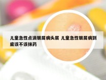 儿童急性点滴银屑病头屑 儿童急性银屑病到底该不该抹药