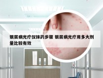 银屑病光疗仪抹药步骤 银屑病光疗用多大剂量比较有效