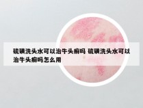 硫磺洗头水可以治牛头癣吗 硫磺洗头水可以治牛头癣吗怎么用