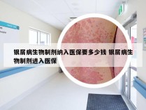 银屑病生物制剂纳入医保要多少钱 银屑病生物制剂进入医保