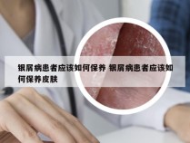 银屑病患者应该如何保养 银屑病患者应该如何保养皮肤