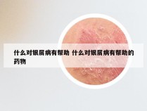 什么对银屑病有帮助 什么对银屑病有帮助的药物