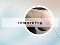 2023年牛皮癣怎么治