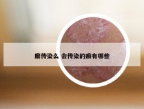 廨传染么 会传染的癣有哪些