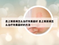 患上银屑病怎么治疗效果最好 患上银屑病怎么治疗效果最好的方法