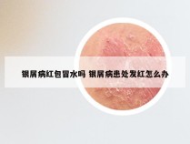 银屑病红包冒水吗 银屑病患处发红怎么办