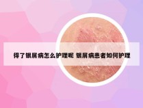 得了银屑病怎么护理呢 银屑病患者如何护理