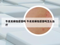 牛皮皮癣怕感冒吗 牛皮皮癣怕感冒吗怎么治疗