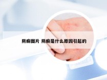 阴癣图片 阴癣是什么原因引起的