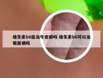 维生素b6能治牛皮癣吗 维生素b6可以治银屑病吗