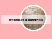 铜钱癣是什么样的 铜钱癣要咋样治