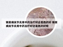 银屑病关节炎用中药治疗好还是西药好 银屑病关节炎用中药治疗好还是西药好呢