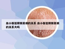 血小板低跟银屑病的关系 血小板低跟银屑病的关系大吗