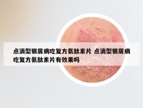 点滴型银屑病吃复方氨肽素片 点滴型银屑病吃复方氨肽素片有效果吗