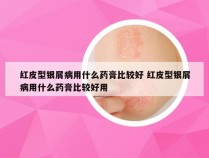 红皮型银屑病用什么药膏比较好 红皮型银屑病用什么药膏比较好用