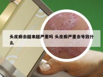 头皮癣会越来越严重吗 头皮癣严重会导致什么