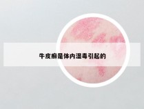 牛皮癣是体内湿毒引起的