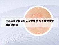 红皮病性银屑病复方甘草酸苷 复方甘草酸苷治疗银屑病