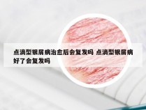 点滴型银屑病治愈后会复发吗 点滴型银屑病好了会复发吗