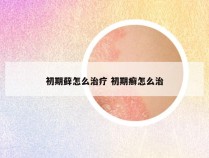 初期藓怎么治疗 初期癣怎么治