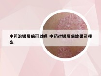 中药治银屑病可以吗 中药对银屑病效果可观么