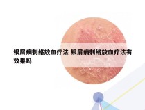 银屑病刺络放血疗法 银屑病刺络放血疗法有效果吗