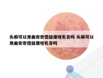 头癣可以用曲安奈德益康唑乳膏吗 头癣可以用曲安奈德益康唑乳膏吗