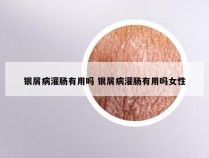 银屑病灌肠有用吗 银屑病灌肠有用吗女性