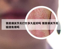 银屑病关节炎打针多久能好吗 银屑病关节炎输液有用吗