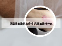 凤凰油能治头皮癣吗 凤凰油治疗什么