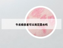 牛皮癣患者可以用花露水吗