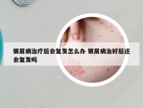 银屑病治疗后会复发怎么办 银屑病治好后还会复发吗