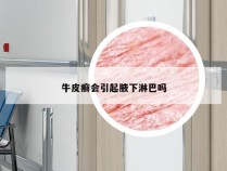 牛皮癣会引起腋下淋巴吗